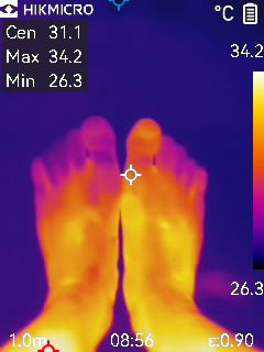 冷え性の人の足先：夏の時期でのサーモグラフィ